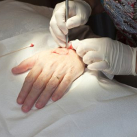 Mohs Surgery vs. Superficial Radiation Therapy